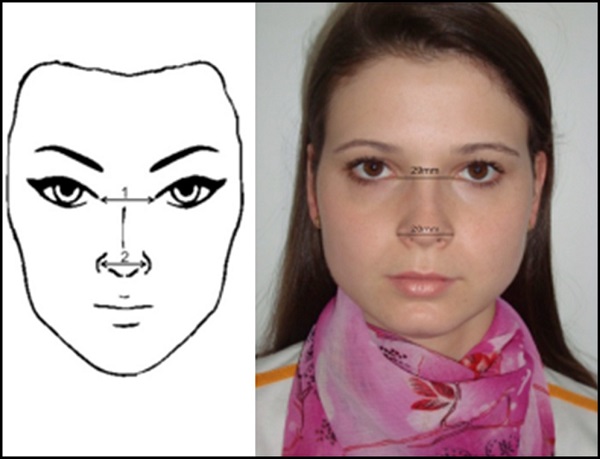 Frontal view: intercanthal distance (1) and alar distance
                                    (2). Figure on the left: schematic model. Figure on the right:
                                    one of the volunteers in the study.
