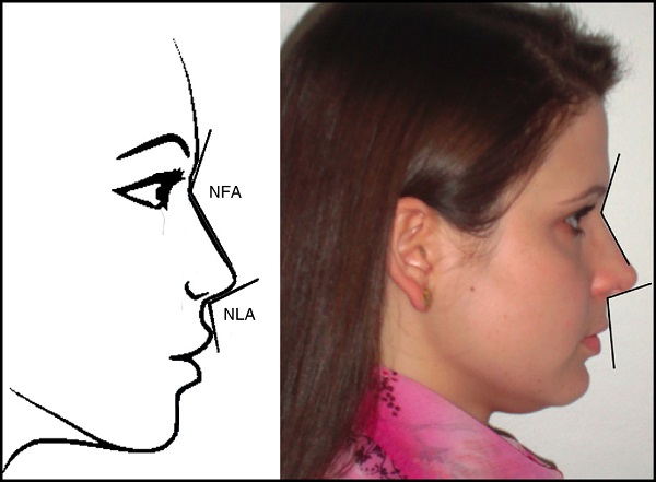 Lateral view: nasofrontal angle (NFA), nasolabial angle
                                    (NLA). Figure on the left: schematic model. Figure on the right:
                                    one of the volunteers in the study.