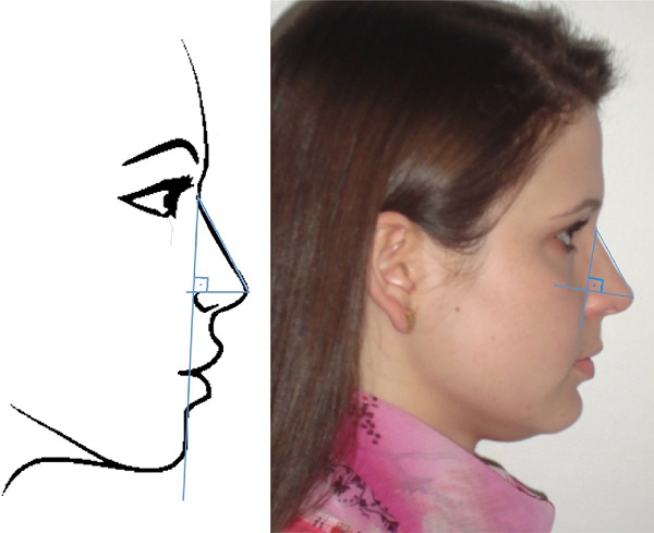 Lateral view: projection of the nasal tip, Goode's method. To
                                    calculate Goode's ratio, first a vertical line is drawn from the
                                    nasion to the alar sulcus. Then, a horizontal line is drawn to
                                    the pronasion, perpendicular to this line. The distance from the
                                    nasion to the pronasion is then measured. Goode's Ratio is
                                    obtained by dividing the alar point to the pronasion by the
                                    nasion-pronasion distance. Figure on the left: schematic model.
                                    Figure on the right: one of the volunteers in the study.