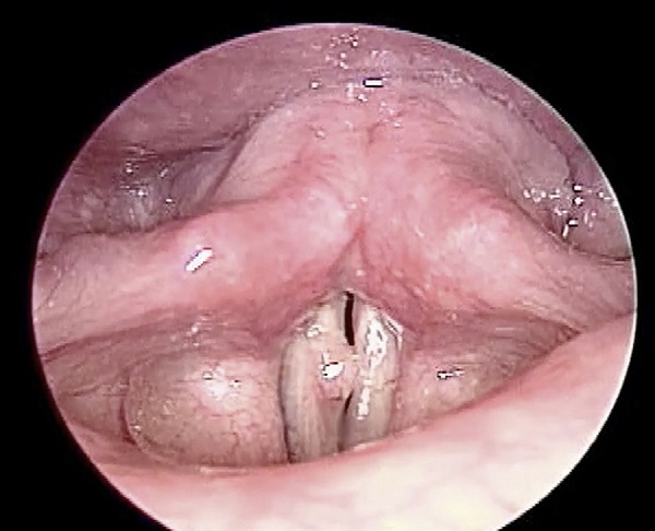 Preoperative indirect laryngoscope finding: a white tumor lesion was
                            at right vocal fold with mucosal cover and unclear border which led to
                            failure of glottis closure during phonation.