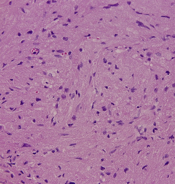 The tumor comprised round or polygonal cells with abundant
                            eosinophilic granular cytoplasm and small uniform nuclei arranged in
                            nest and sheet patterns (H&E, 400×).