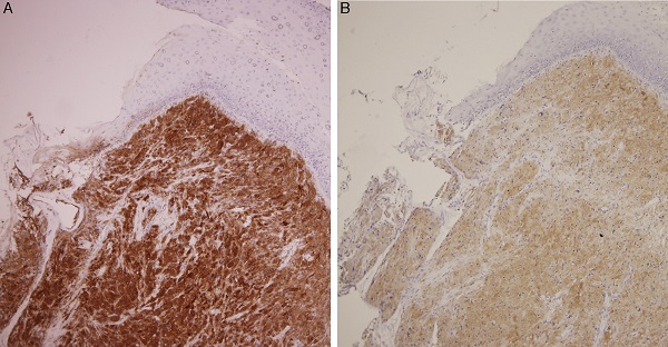 (A) Positive S-100 immunostain. (B) Positive neuron-specific enolase
                            immunohistochemical staining denoted its neuroectodermal origin.