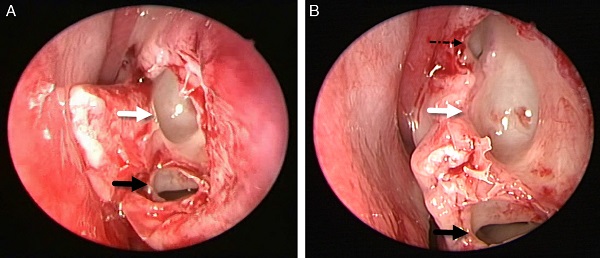 Intraoperative findings. Figures show upper ICB connecting with the
natural ostium of the maxillary sinus and lower ICB (left) (black arrow,
lower ICB; white arrow, upper ICB; dotted arrow, natural ostium of
maxillary sinus).