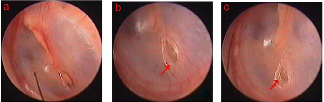 Spontaneous healing process of small perforation: (A-C) was the 1 day, 5 days
                and 8 days following perforation. Red indicated epithelium proliferation at the
                edge.