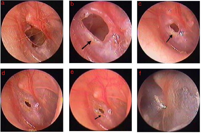 The healing process of perforation after Gelfoam patching: (A) 1st following
                perforation; (B-E) 2, 4, 7, and 9 days, and 2 weeks after Gelfoam patching. Black
                arrows indicate granulation tissue, edema, and exudate at the margin.