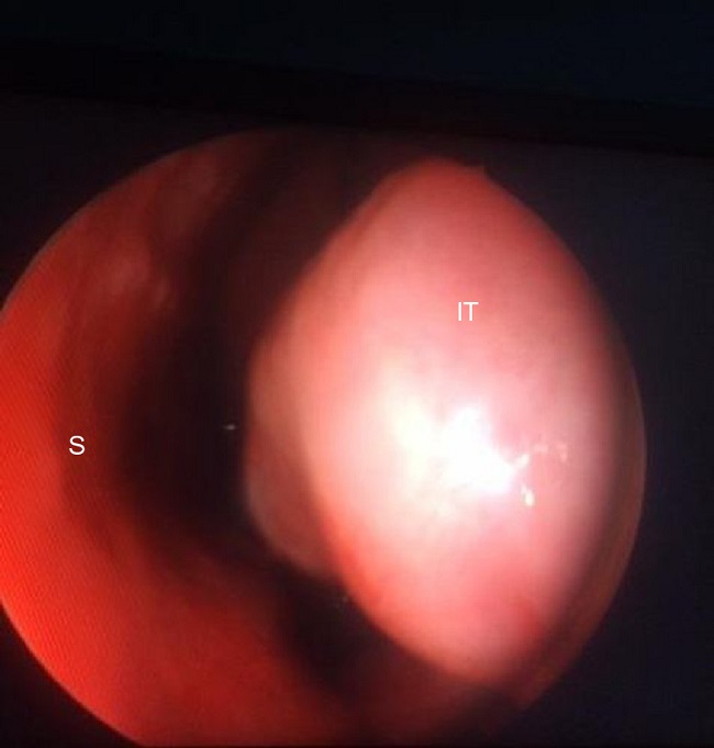 An endoscopic image of the left nasal cavity. Hypertrophic inferior
                            turbinate of a patient before radiofrequency ablation is demonstrated.
                            S, Septum; IT, Inferior Turbinate.
