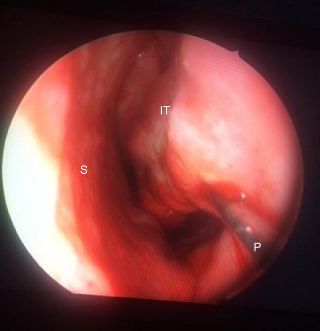 An image showing the reduction of left inferior turbinate of a
                            patient using radiofrequency ablation technique. A conchal probe is
                            inserted into the submucosal plane of inferior turbinate, and posterior,
                            middle and anterior one thirds of the turbinate are ablated by a total
                            of 300 J of energy. S, Septum; IT, Inferior Turbinate; P, Conchal
                            probe.