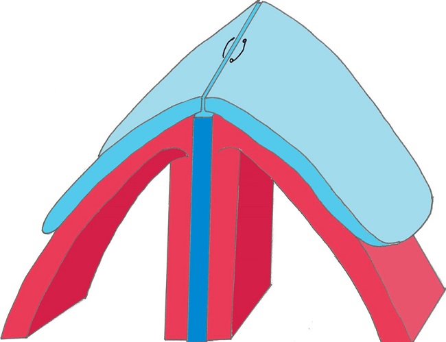 Schema for approximation of the upper lateral cartilages (light
                                blue) over the septum (dark blue). The mucopericondrium is shown in
                                red.