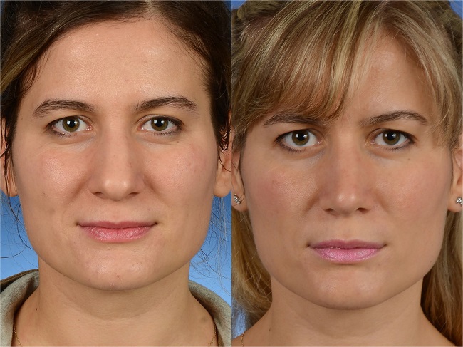 Corrected dorsal esthetic line with normal middle vault wideness is
                            seen preoperative (left) and postoperative (right) frontal views. Her
                            Visual Analog Scale (VAS) score for esthetic appearance of the nose was
                            86%, and her ROE score was 83%.