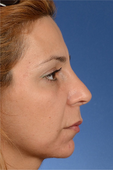 Iatrogenic cartilaginous hump as a result of inadequate adjustment of
                            the septal height. Her VAS score for esthetic appearance of the nose was
                            86%, and her ROE score was 58%.