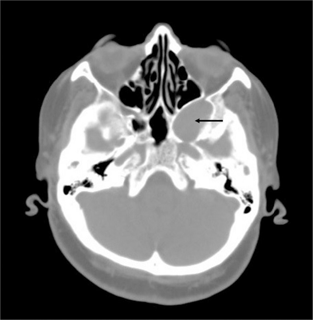 Preoperative axial CT scan. CT scan shows a soft tissue mass, which
                            is located in the pterygopalatine fossa, causing expansion of the left
                            cavernous sinus. Also, it pushes the posterior wall of the maxillary
                            sinus toward the anterior, and the lateral wall of the sphenoid sinus
                            toward the medial (arrow indicates tumor).