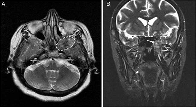(A) Preoperative T1-weighted axial MRI. The mass is hypointense on
                            the T1-weighted images (dashed-line indicates tumor). (B) Preoperative
                            T2-weighted coronal MRI. The mass is mildly hyperintense on the
                            T2-weighted images (arrow indicates tumor).
