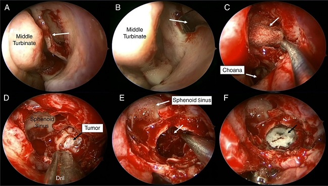 Intraoperative view. (A) Uncinate process was removed by backbiter
                            forceps and later the ostium of the maxillary sinus was identified
                            (arrow indicates uncinate process). (B) The medial wall of the maxillary
                            sinus was removed and wide meatal antrostomy was made (arrow indicates
                            maxillary sinus). (C) The anterior wall of the sphenoid sinus was
                            removed partially and sphenoidotomy was made (arrow indicates nasal
                            packing in the sphenoid sinus). (D) Posterior wall of the maxillary
                            sinus was removed partially and the tumor was seen in pterygopalatine
                            fossa. (E) Tumor was excised totally (arrow and aspirator indicate
                            pterygopalatine fossa). (F) At the end of the surgery absorbable
                            hemostat was filled into the pterygopalatine fossa (arrow indicates
                            absorbable hemostat).