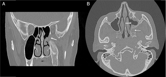Postoperative CT images. (A) Coronal CT scan. There is no tumor
                            recurrence in the pterygopalatine fossa (arrow indicates pterygopalatine
                            fossa). (B) Axial CT scan. Left maxillary sinus and pterygopalatine
                            fossa are seen normal (arrow indicates wide meatal antrostomy and dashed
                            arrow indicates pterygopalatine fossa).