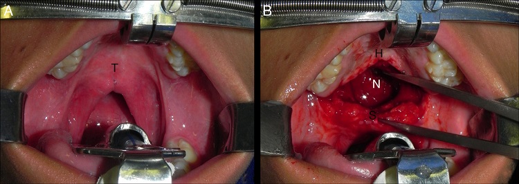 A, Intraoperative intra-oral photograph showing the scars at the
                                junction of the hard and soft palate. B, Intraoperative intra-oral
                                photograph demonstrating the defect created between the hard and
                                soft palates after radical detachment of the palatine veil and
                                mobilization of the soft palate toward the posterior pharyngeal wall
                                ("T", transition between hard and soft palates; H, hard palate; "S",
                                soft palate; "N", nasopharynx).