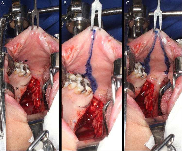 Intraoral photographs of the demarcation and creation of the
                                buccinator myomucosal flap. A, Marking of the Stensen duct exit with
                                methylene blue. B, Delimitation of the cranial portion passing just
                                below the Stensen duct exit. C, Delimitation of the caudal portion
                                parallel to the cranial portion and the anterior portion near the
                                oral opening ("H", hard palate; "S", soft palate; "N",
                                nasopharynx).