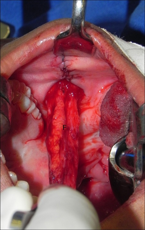 Intraoral photograph showing the buccinator myomucosal flap and
                                synthesis of the donor area without tension ("F", buccinator
                                flap).