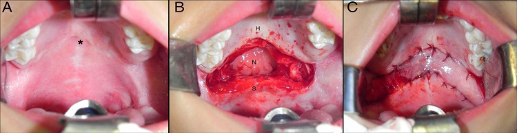 Intraoperative photographs showing: A, palatal scars; B, the
                                defect created between the hard and soft palate and C, the
                                reconstruction of the defect with the bilateral buccinator
                                myomucosal flap (*, scars; "H", hard palate; "S", soft palate; "N",
                                nasopharynx; "F", buccinator flap).