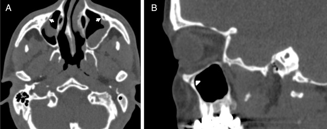 (A) Axial paranasal sinus CT image showing right-sided
                                        infraorbital canal Type 1 within the maxillary bony roof and
                                        left-sided infraorbital canal Type 2 partially protruding
                                        into maxillary sinus (thick arrows). (B) Right parasagittal
                                        image showing infraorbital canal Type 1 (arrowhead).