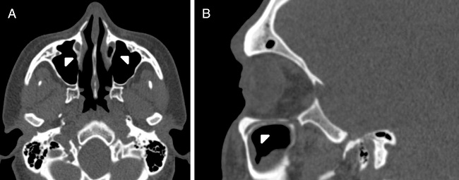 (A) Axial paranasal sinus CT image showing bilateral
                                        infraorbital canal Type 2 partially protruding into the
                                        maxillary sinus (arrowheads). (B) Right parasagittal image
                                        showing infraorbital canal Type 2 (arrowhead).