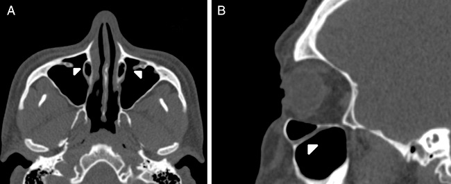 (A) Axial paranasal sinus CT image showing bilateral
                                        infraorbital canal Type 3 totally protruding into the
                                        maxillary sinus with a stalk (arrowheads). (B) Right
                                        parasagittal image showing infraorbital canal Type 3
                                        (arrowhead).