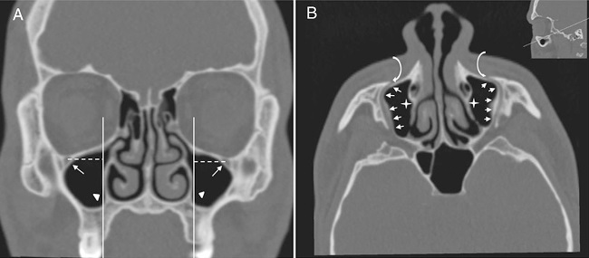 (A) Coronal paranasal sinus CT image showing bilateral
                                        infraorbital canal Type 4 which is located at the outer
                                        limit of the zygomatic recess and the horizontal distance
                                        (white dashed line) from the center of the IOF (arrows) to
                                        the plane passing through the priform aperture (arrowheads).
                                        (B) An oblique/axial image showing bilateral lateroantral
                                        canals (arrows) which are identified coursing laterally to
                                        the maxillary sinuses (asterisks) and opened by infraorbital
                                        foramina (curved arrows).
