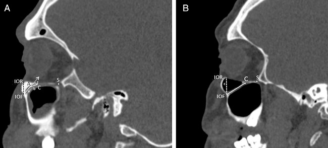 Measurements regarding to infraorbital canal, foramen and groove. A,
                            Right parasagittal image showing the infraorbital canal with an internal
                            angulation. The length of the IOC1 (a) was the distance from the center
                            of the infraorbital foramen (IOF) to the internal angulation point (A).
                            The length of the IOC2 (b) was the distance from the internal angulation
                            point (A) to the anterior margin of the infraorbital groove (C). The
                            length of the IOG was the distance from the anterior (C) to posterior
                            margin of the infraorbital groove (S). The measurements of the internal
                            angulation of the IOC (z) and the distance
                                (c) from the infraorbital rim (IOR) to the center
                            of the infraorbital foramen (IOF). B, Right parasagittal image showing
                            infraorbital canal without internal angulation. The measurements of the
                            length of the infraorbital canal (a +
                                b) and the distance (c) from the
                            infraorbital rim (IOR) to the center of the infraorbital foramen (IOF).
                            The anterior (C) and posterior margin of the infraorbital groove (S)
                            were identified.