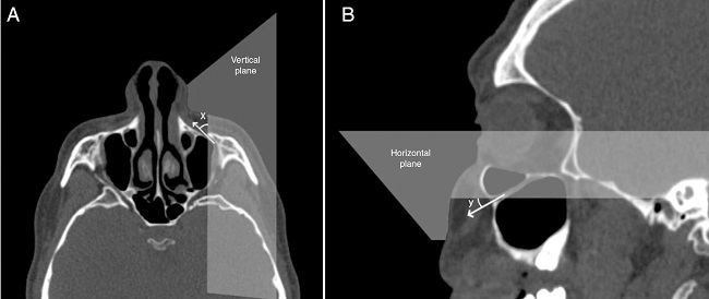 Angular measurements of the entry into infraorbital foramen in axial
                            and sagittal sections. (A) The angle (x) was the angle
                            of the axis of the infraorbital canal relative to the vertical plane
                            that passed through the center of the infraorbital foramen. (B) The
                            angle (y) was the angle of the axis of the IOC relative
                            to horizontal plane that passed through the center of the IOF.