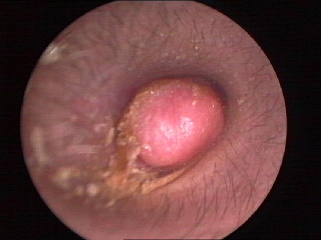 Endoscope test showing a pink, ovary-shaped neoplasm with a smooth
                            surface. The tympanic membrane was covered without adhering to the
                            adjacent structure.