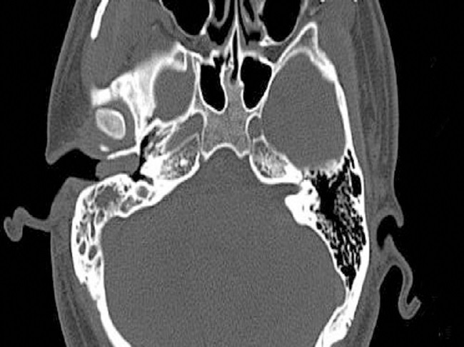 Axial CT scan before surgery showing a well-circumscribed strip of
                            solid mass in the right external auditory canal without bony erosion and
                            a medium-density area in the tympanic antrum.