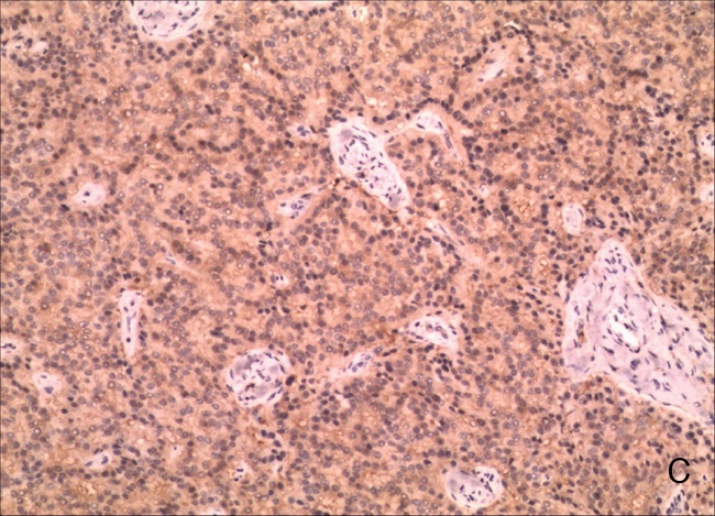 Immunohistochemistry for neuron-specific enolase (NSE) (magnification
                            100&times;).