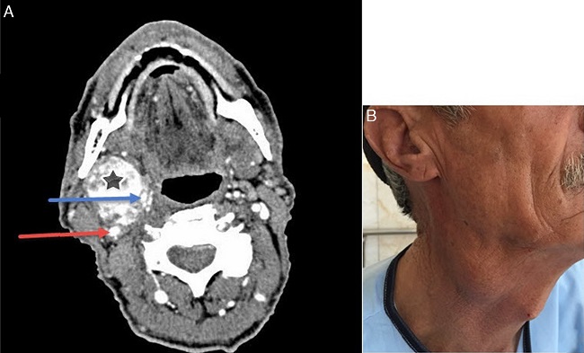 (A) Spiral neck CT scan with IV contrast shows CBT (star), ICA (red
                            arrow) and ECA (blue arrow). (B) A 60 year-old man with a painless,
                            non-pulsatile right neck mass since 40 years ago.