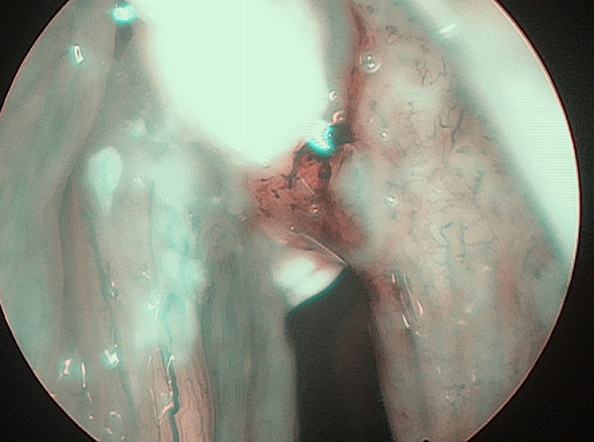 Glottic cancer in narrow-band imaging (NBI).