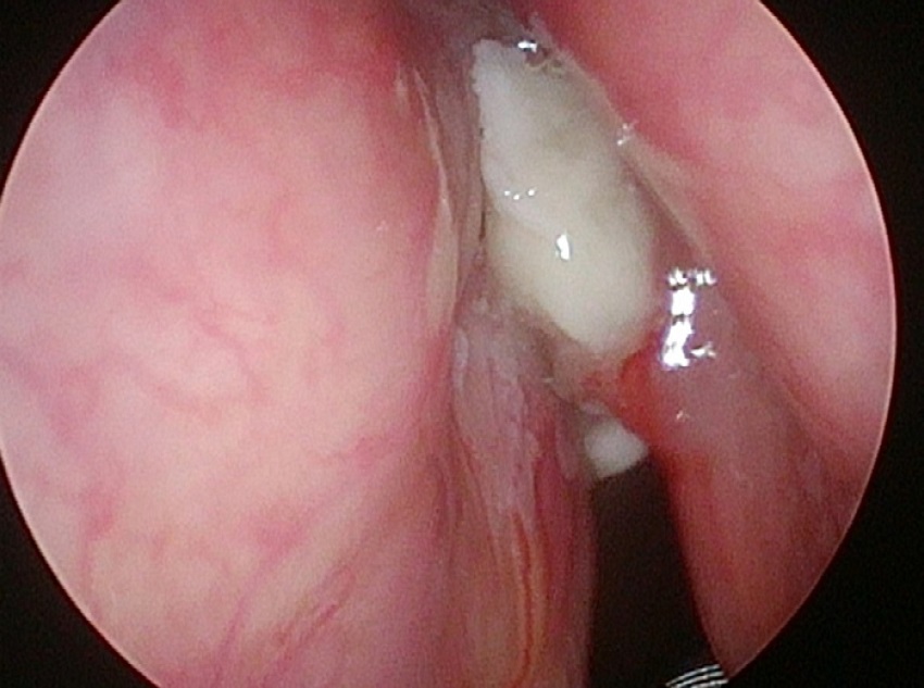 Glottic cancer in white light (WL).