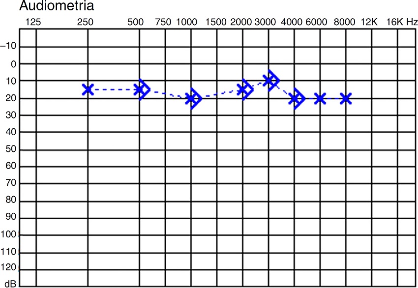 Audiograms of case 1.
