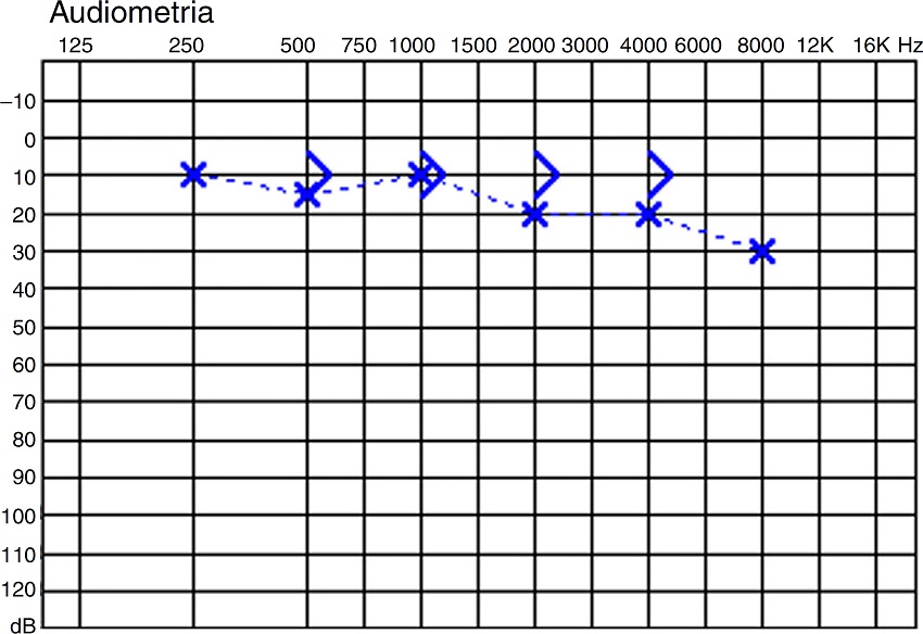 Audiogram of case 3.