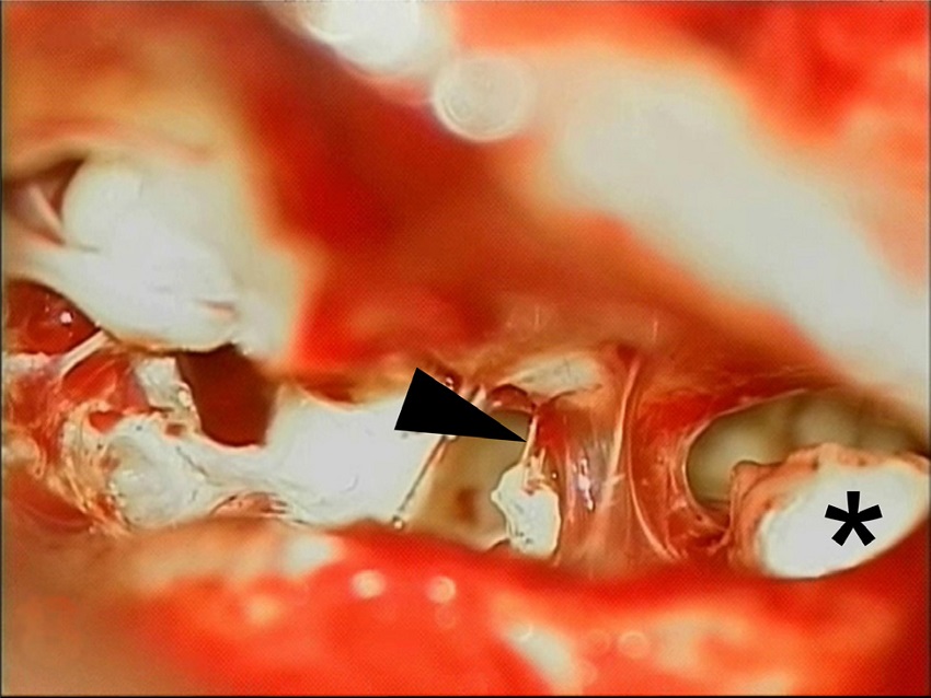 Photograph of case 5 with posterior tympanotomy view of the
                                middle ear. The arrow points to the fibrous bridge linking the
                                malleus to the stapes head. A residual cholesteatoma is seen on
                                right (*).