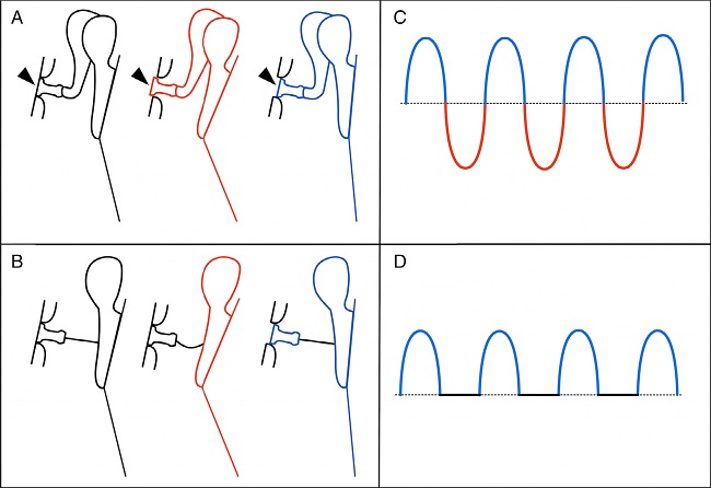 Schematic drawing demonstrating the tympano-ossicular unit movement
                            in normal situation (A) and with the fibrous bridge (B). The black color
                            represents the rest (neutral) position, the compression phase is
                            represented in red, and the rarefaction phase, in blue. Note, on A, the
                            normal behavior of the stapes on oval window (arrowheads), penetrating
                            into the vestibule during the compression (red), and coming out of it
                            during the rarefaction (blue). On B, only the rarefaction produces a
                            stapes movement. On right (C and D), the graphical representation of the
                            resulting perilymph wave is depicted. Note that, in D, only the
                            rarefaction phase is present.