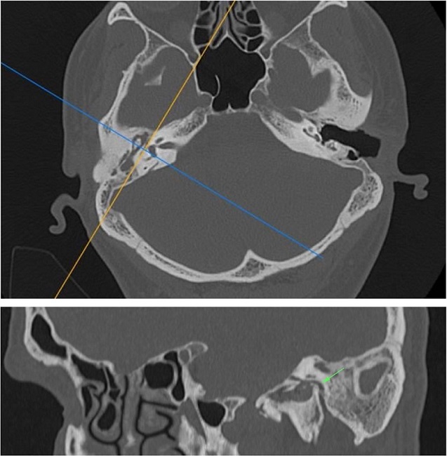 (A) and (B) Reformatted sagittal images were obtained from thin-section
                        axial MDCT images. Angle at the second genu, tympanic, and mastoid segments
                        of the facial nerve (arrow) were demonstrated.