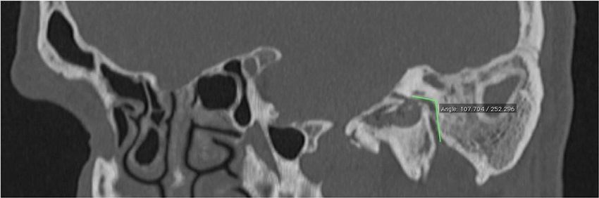 Parallel lines from the tympanic and mastoid segments of the facial
                        nerve were drawn in sagittal reformatted images.