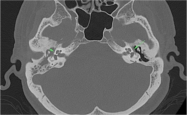 In the right middle ear cavity and mastoid antrum, there was a soft
                        tissue density proven as cholesteatoma. Also, dehiscence in the tympanic
                        segment of the facial canal (arrowhead) was seen on the right side. Tympanic
                        segment of the facial canal (arrow) was intact on the left side.