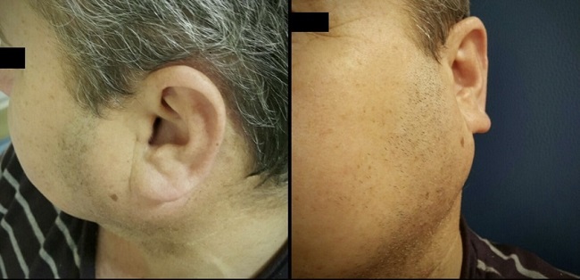 61-Year old patient with left parotid mass, on admission to the
hospital.