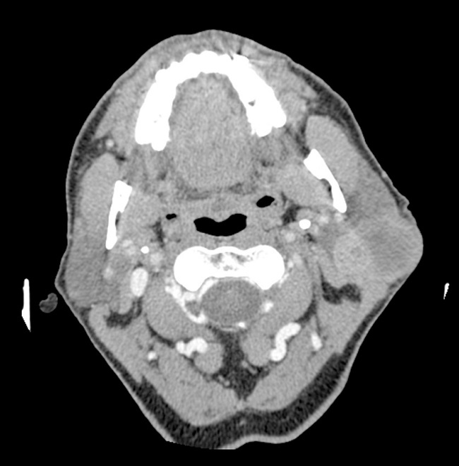 An enhanced CT scan of the parotid gland. Heterogeneously enhanced, left
parotid mass, involving both lobes of the gland.