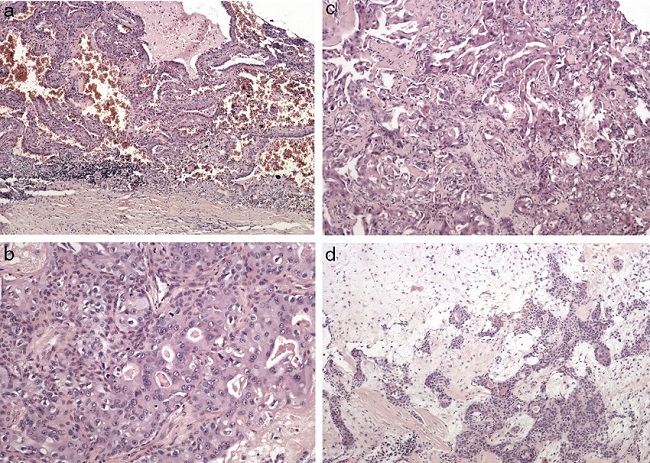 The histopatology of the resected specimen showing (A) Warthin tumor
composed of lymphoid and epithelial cells, (B, C) malignant epithelial cells of
carcinoma ex pleomorphic adenoma, in the background of (D) pleomorphic
adenoma.