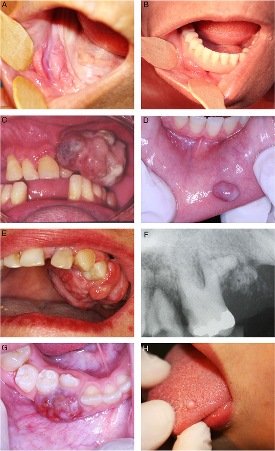 (A) Inflammatory fibrous hyperplasia; (B) ill-fitting denture over
                            the inflammatory fibrous hyperplasia; (C) oral pyogenic granuloma in the
                            alveolar ridge; (D) oral pyogenic granuloma in the lower lip; (E)
                            peripheral ossifying fibroma; (F) periapical radiography of the
                            peripheral ossifying fibroma; (G) peripheral giant cell lesions; (H)
                            giant cell fibroma.