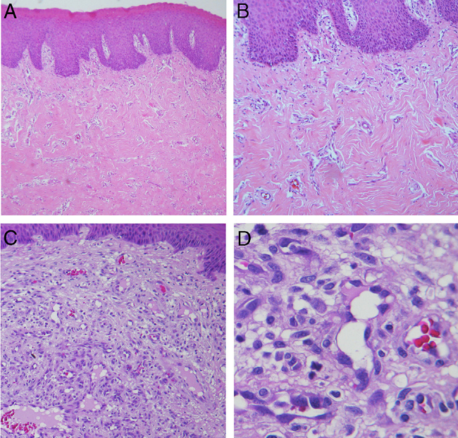 Hematoxylin and eosin staining. (A) Inflammatory fibrous hyperplasia
                            (40&times;); (B) high magnification of the same case showing thick
                            collagen fibers (100&times;); (C) oral pyogenic granuloma
                            (100&times;); (D) high magnification of the same case showing greater
                            number of endothelial cells and newly formed blood vessels
                            (400&times;); (E) giant cell fibroma, with thin and long epithelial
                            projections (100&times;); (F) high magnification of the same case
                            showing the presence of stellate-shaped (arrow) and multinucleated
                            (arrowhead) fibroblasts (400&times;); (G) peripheral ossifying fibroma,
                            with mineralized product in the connective tissue (40&times;); (H) high
                            magnification of the same case demonstrating irregular bone trabeculae
                            formed (100&times;); (I) peripheral giant cell lesions (100&times;);
                            (J) high magnification of the same case with large number of
                            multinucleated giant cells associated with hemorrhagic areas
                            (400&times;).