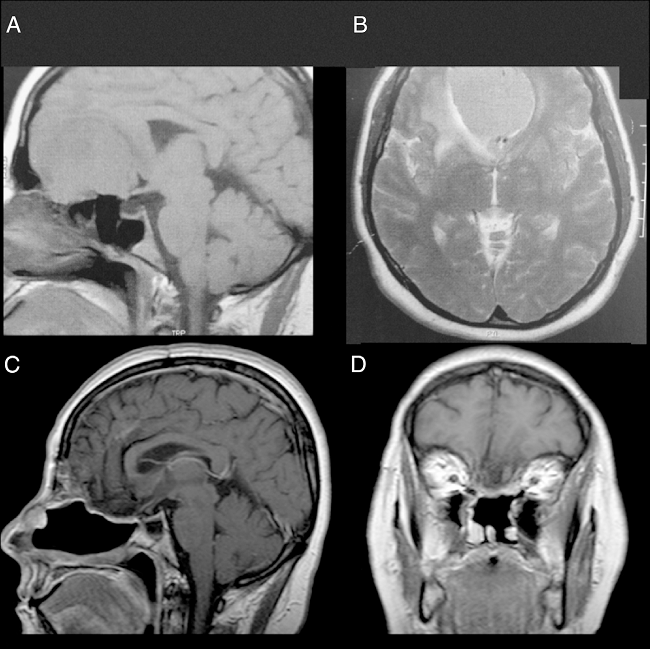 Patient 1, female, 49 years old. (A, B) Preoperative MRI without
a contrast showing a large mass in the anterior fossa with mass
effect. The anterior cerebral arteries are displaced posteriorly and
there is invasion of the anterior and posterior ethmoid. (C, D)
Postoperative 4 years MRI with contrast, showing gross total
resection and no signs of tumour recurrence or brain herniation.
Both flaps can be seen with gadolinium enhancement and preservation
of the pedicles and viability of the endoscopic double flap.