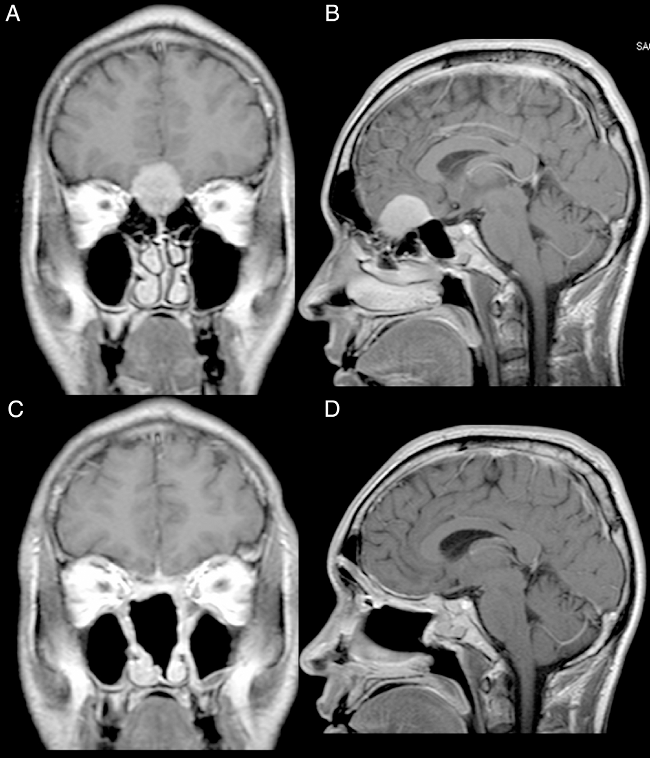 Patient 2, male, 39 years old. (A, B) Preoperative MRI with
contrast showing an intracranial mass with dural attachment and
invasion of the anterior and posterior ethmoid. (C, D) Postoperative
1 year MRI with contrast, showing gross total resection and no signs
of tumour recurrence or brain herniation. Both flaps can be seen
with gadolinium enhancement and preservation of the pedicles and
viability of the endoscopic double flap.