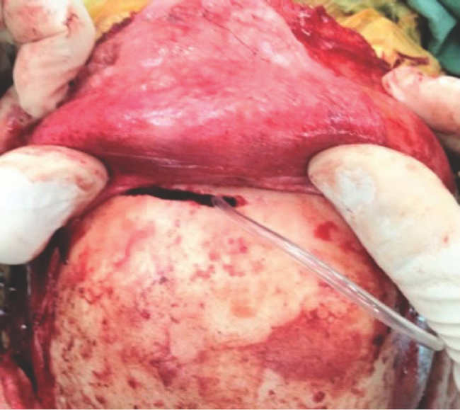Intraoperative picture showing the ‘window' created in the
anterior wall of the frontal sinus for passage of the pericranial
flap.