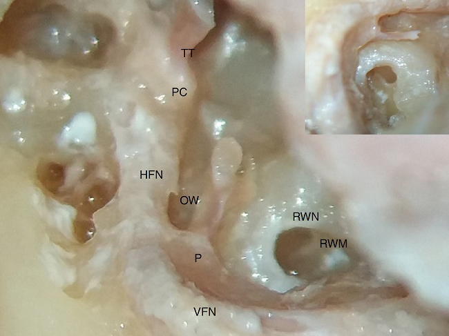 Photograph showing saddle shape of round window membrane (RWM),
                                situated deep in round window niche (RWN). VFN, vertical facial
                                nerve; HFN, horizontal facial nerve; P, pyramid; OW, oval window;
                                PC, processus cochleariformis; TT, tendon of tensor tympani. Inset
                                on right upper corner shows magnified image of round window membrane
                                and stapedius tendon arising from pyramid.